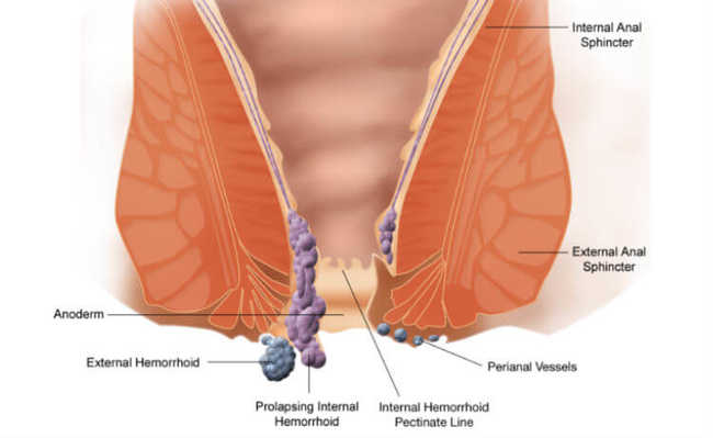 Hemoroizi: ce este, cauze, simptome și cum se trată